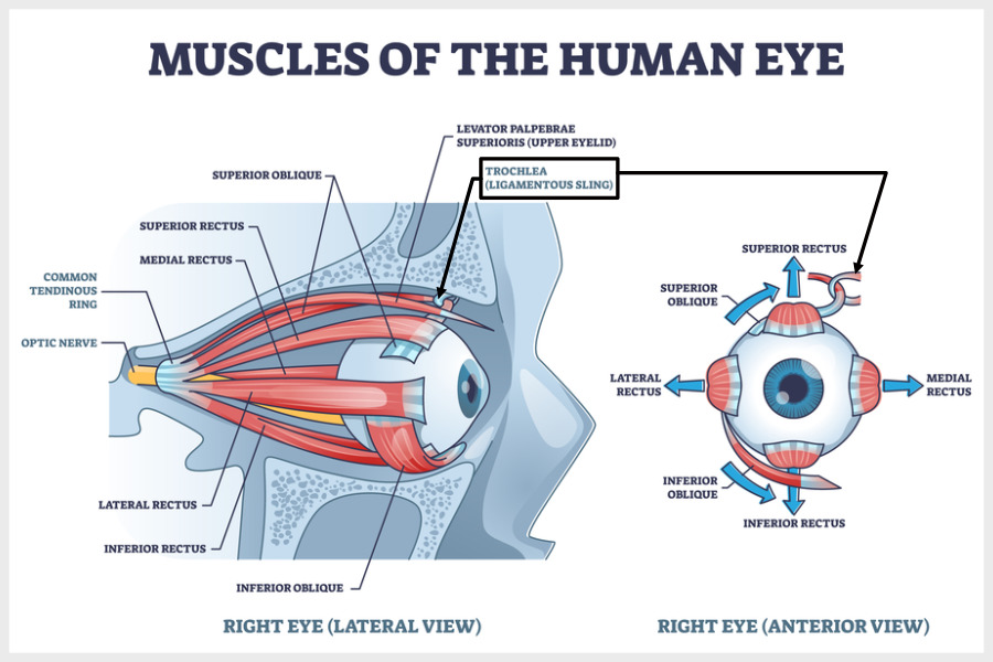 Binocular vision dysfunction leads to an inflamed trochlea: This can trigger cluster headaches