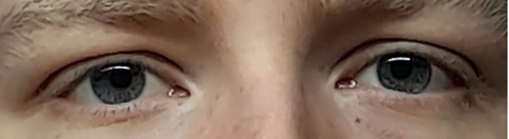 Eine Winkelfehlsichtigkeit kann Clusterkopfschmerzen auslösen