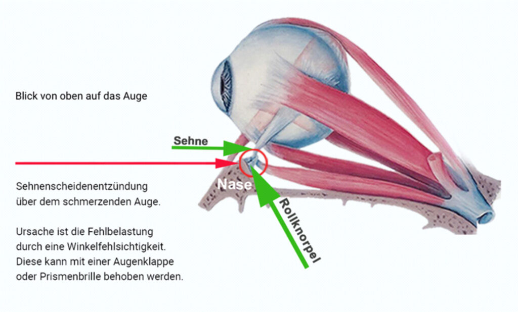 Entzündete Trochlea als Auslöser für Clusterkopfschmerzen