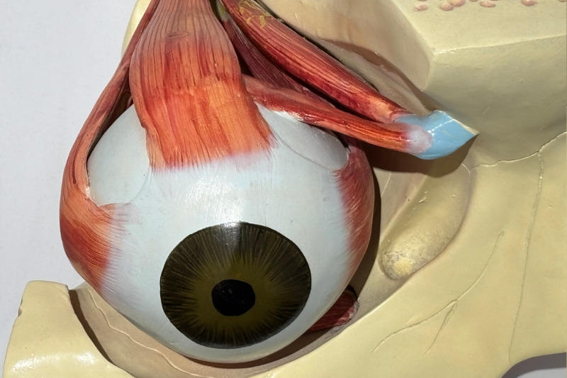 Inflamed trochlea as a trigger for cluster headaches.